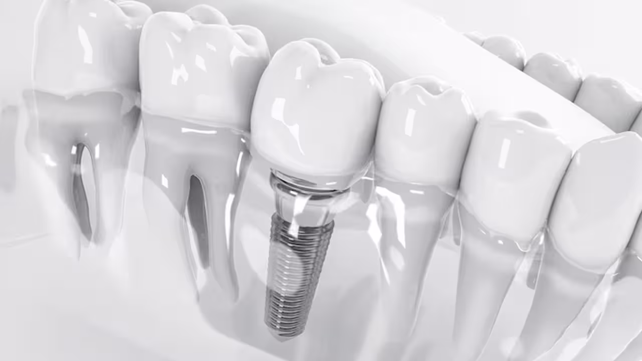 Dental Implants at Yasko Dental Hospital