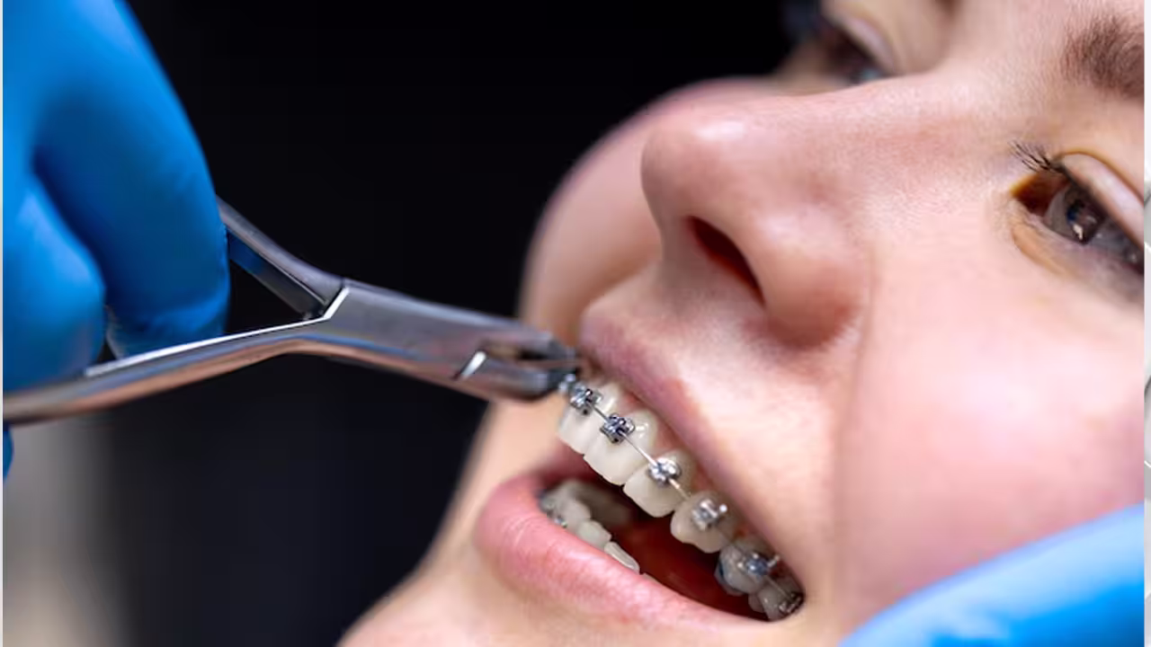 Orthodontics (Braces & Aligners) at Yasko Dental Hospital